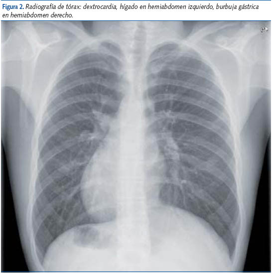 Figura 2. Radiografía de tórax: dextrocardia, hígado en hemiabdomen izquierdo, burbuja gástrica
en hemiabdomen derecho.
